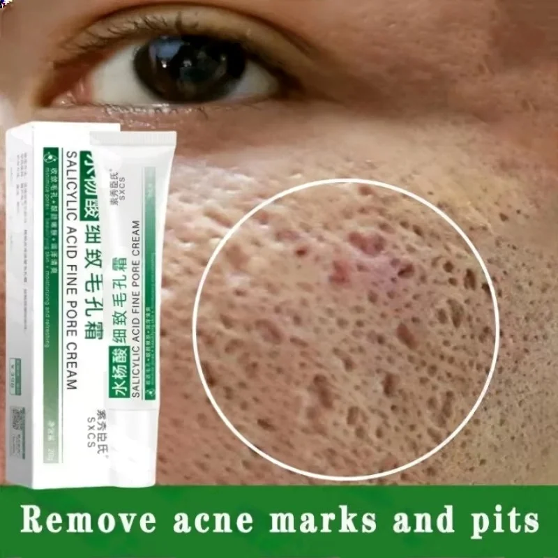 Salicylic Acid Blackhead Remover - サリチル酸毛穴クリアリングクリーム毛穴を縮小黒ずみ除去にきび明るく保湿スムーズなスキンケア韓国製品