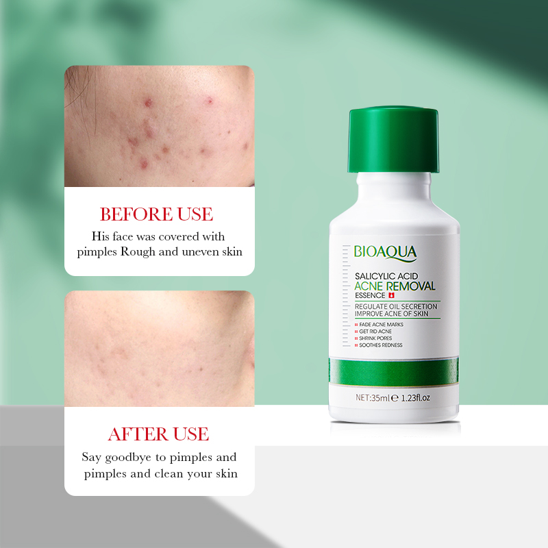 35 ミリリットル BIOAOUA サリチル酸抗ニキビ除去エ - Salicylic Acid Blackhead Remover のレビューと価格