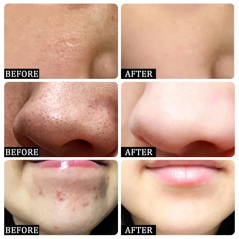 サリチル酸毛穴クリアリングクリーム毛穴を縮小黒ずみ除去にきび - Salicylic Acid Blackhead Remover のレビューと価格