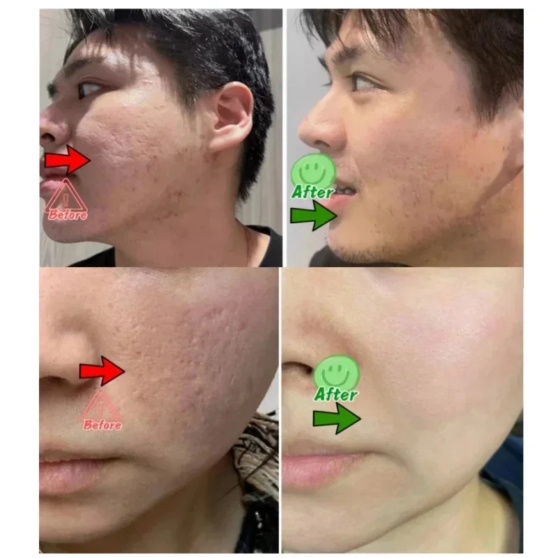 サリチル酸毛穴クリアリングクリーム毛穴を縮小黒ずみ除去にきび - Salicylic Acid Blackhead Remover のレビューと価格