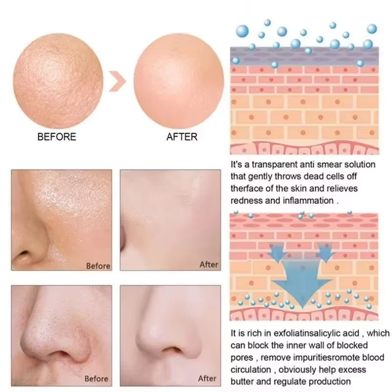サリチル酸毛穴縮小セラム　即効性で大きな毛穴を解消　黒ずみ・ - Salicylic Acid Blackhead Remover のレビューと価格