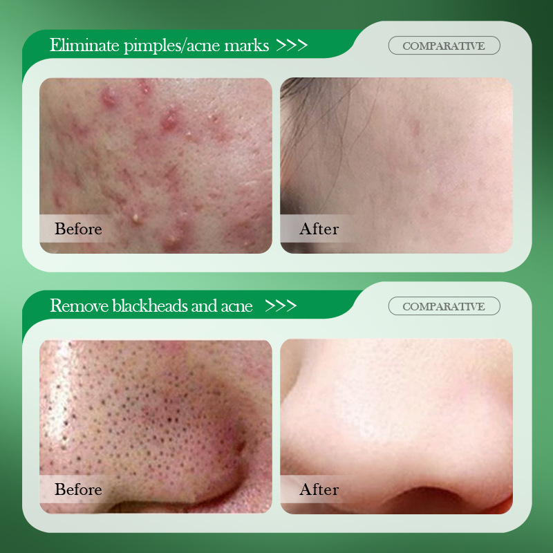 サリチル酸ニキビ治療クリーム修復ニキビ跡除去黒ずみ毛穴縮小オ - Salicylic Acid Blackhead Remover のレビューと価格